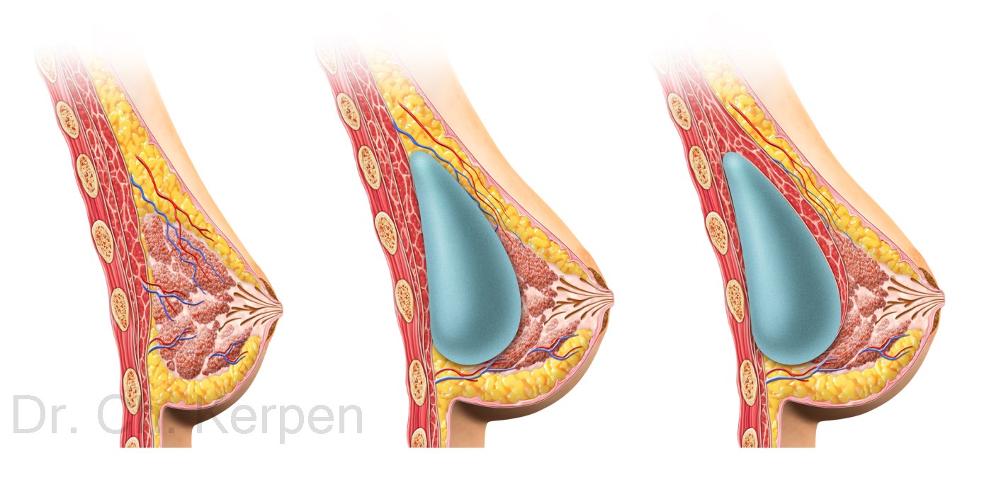 Lage der Silikonimplantate in der Brust bei einer Brustvergrößerung auf (Mitte) oder unter (Rechts) dem großen Brustmuskel