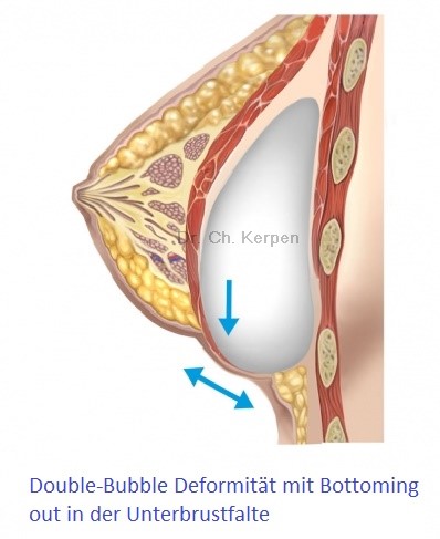 Double Bubble mit Bottoming out nach Brustvergrößerung 